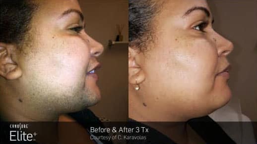Laser Hair Removal VK Skin SPA BROOKLYN NY